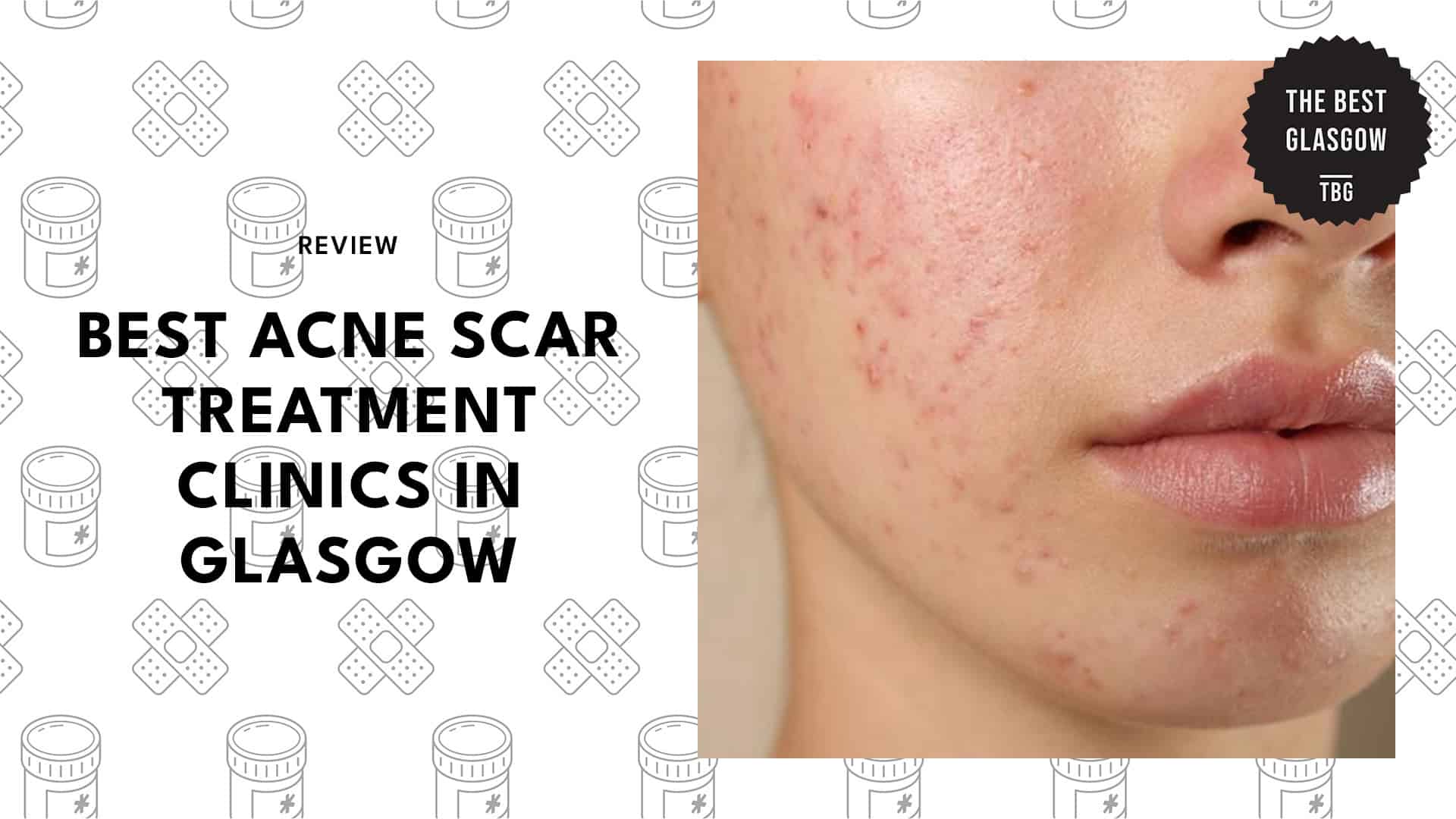 acne-scar-treatment-clinics-in-glasgow